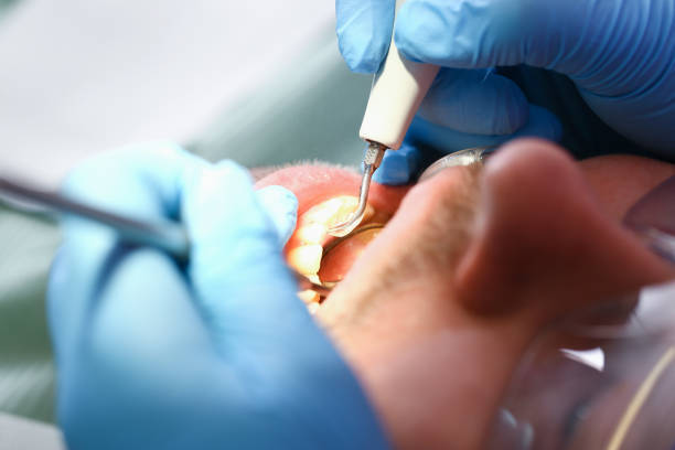 Best Emergency Dentist for Lost Fillings or Crowns in , CT